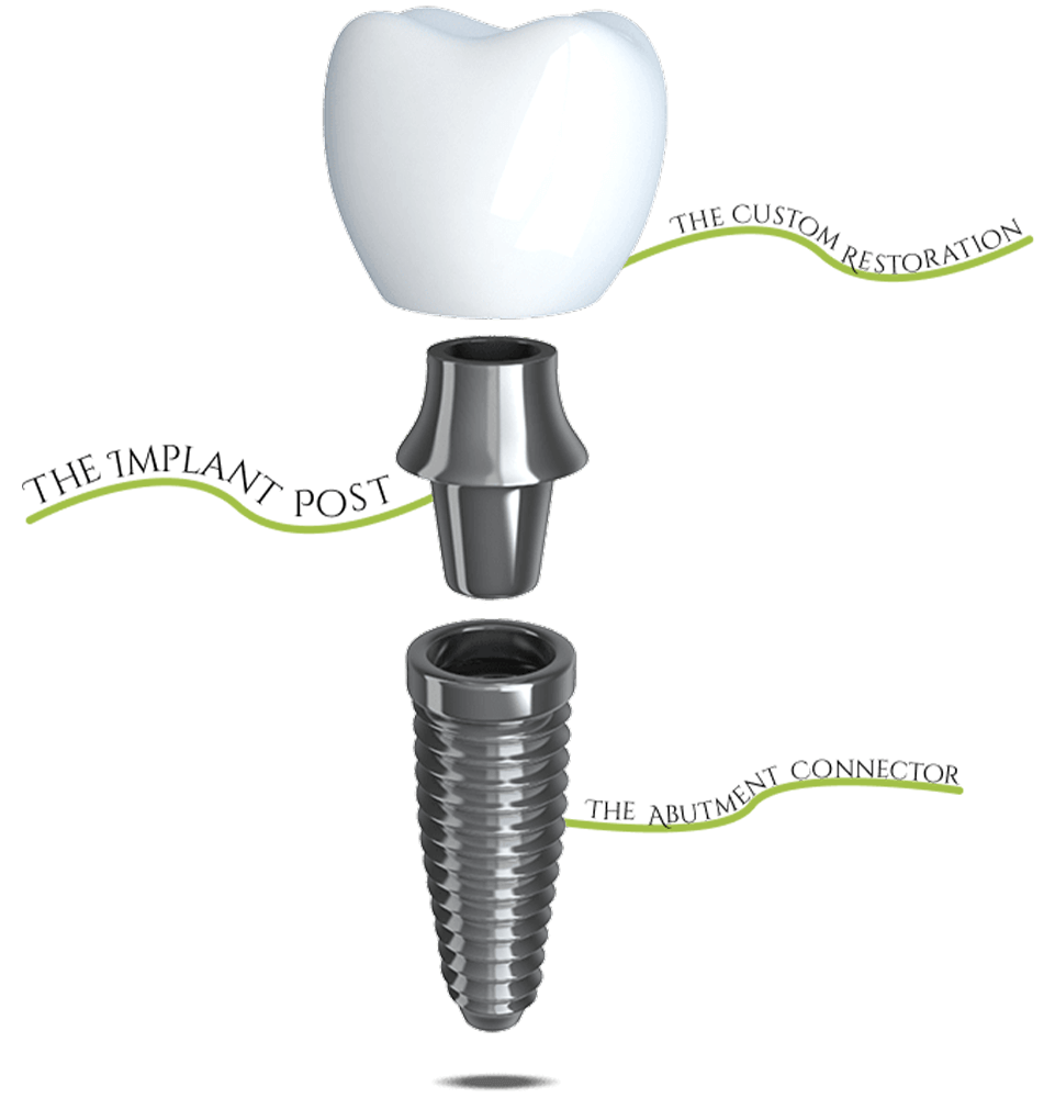 illustrated dental implant with key points