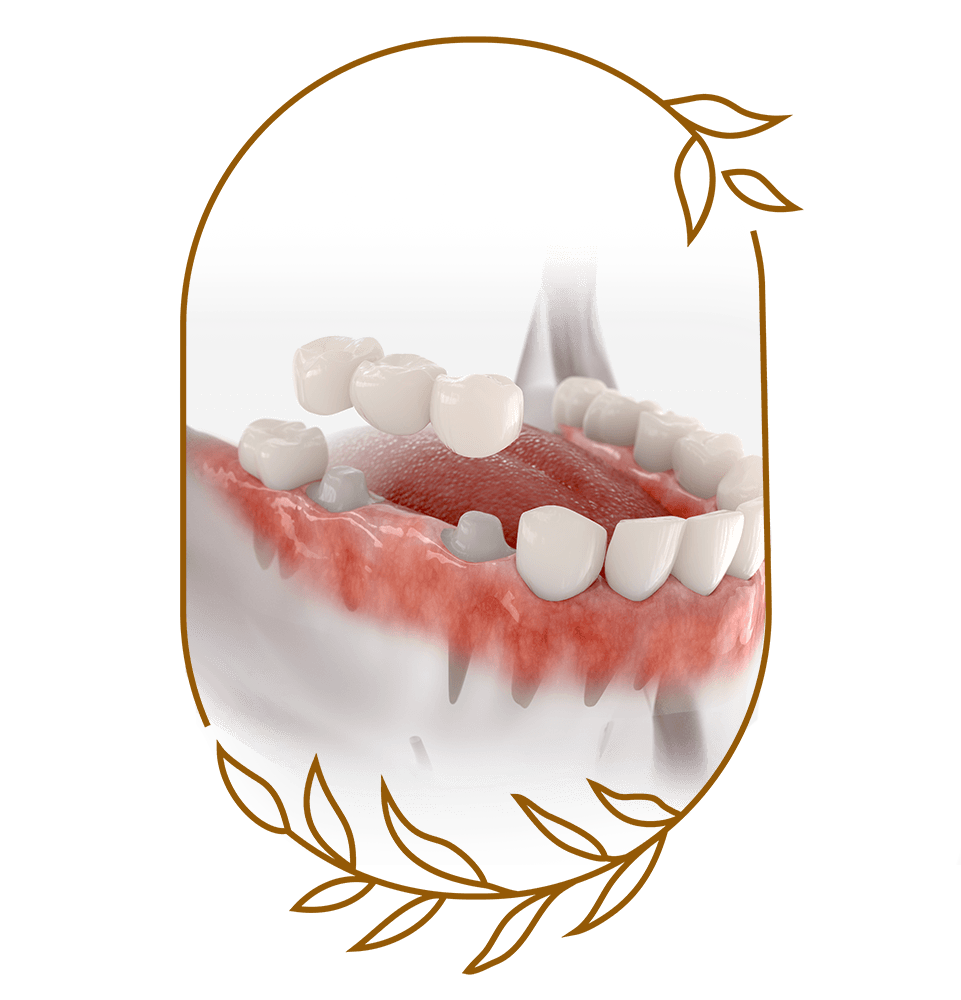 Bridge dental with 3 teeth fixed on molar and premolar