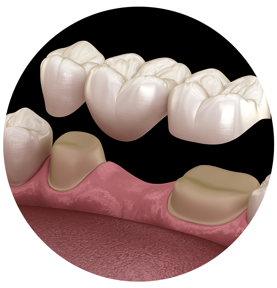 illustration of dental bridge