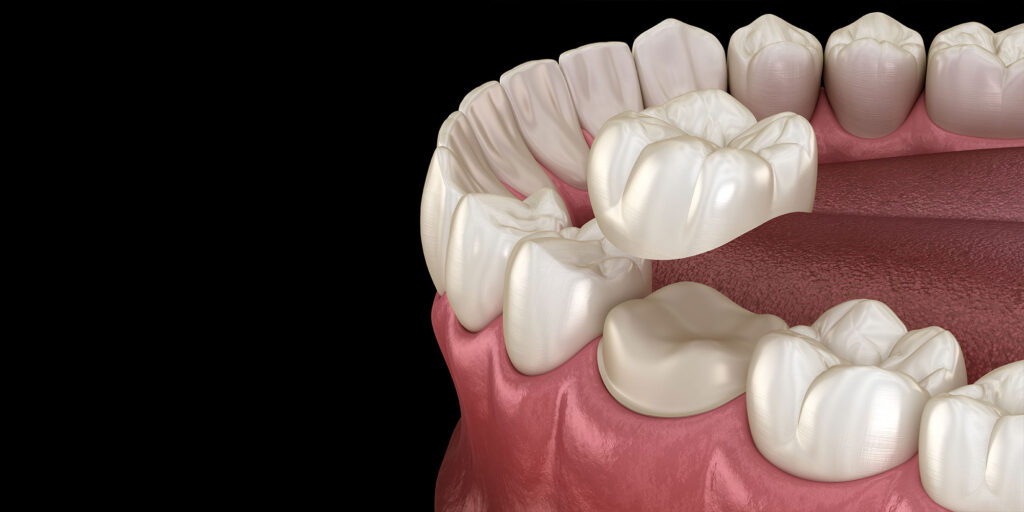 Preparated molar tooth for dental crown placement. Medically accurate 3D